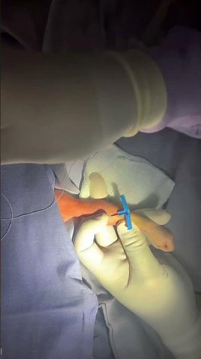 Colocación de catéter PICC #pediatria #neonato #hospital #picc