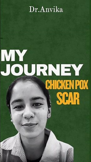 Chicken Pox Scars treatment || Scar Clear Skin Transformation|| by Dr Anvika