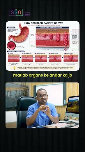 Cancer Spread In Abdomen: What Doctors Really Mean! | Dr Praveen Kammar, Mumbai