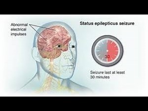 Treatment for Status Epilepticus in Adults