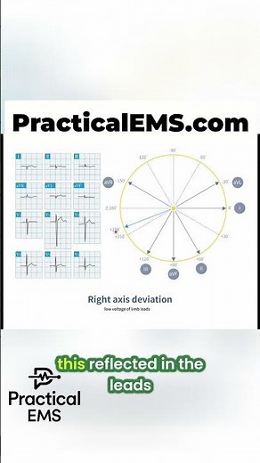 EKG Explained: Spotting Right Axis Deviation FAST! #shorts