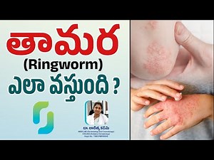 తామర(Ring Worm) ఎలా వస్తుంది? | Thamara Preventions | Dr. Lalithya Kadimi | Dr. Lalithya Derma