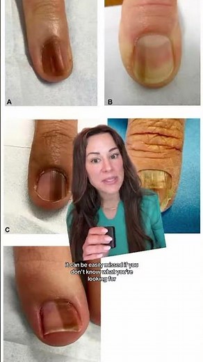 Dermatologist Reveals Dark Vertical Line On Your Nails Could Be Cancer (via Dr Lindsey Zubritsky)