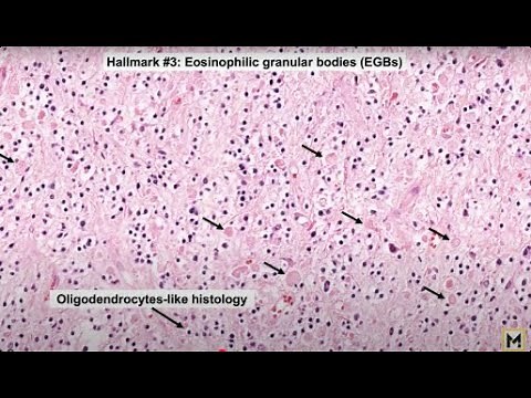 Pilocytic Astrocytoma Explained