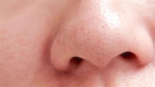 Dermatologist shows how to remove nose blackheads correctly and safely