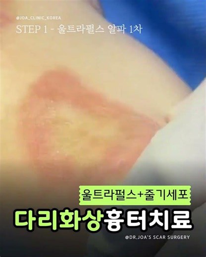 화상흉터의 다양한 접근,[ 울트라펄스 + 줄기세포 ] 조아성형외과의 복합치료#조아성형외과 #JOAPlasticSurgery