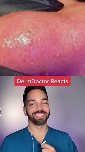 Managing Sebaceous Filaments: Expert Tips for Clearer Skin