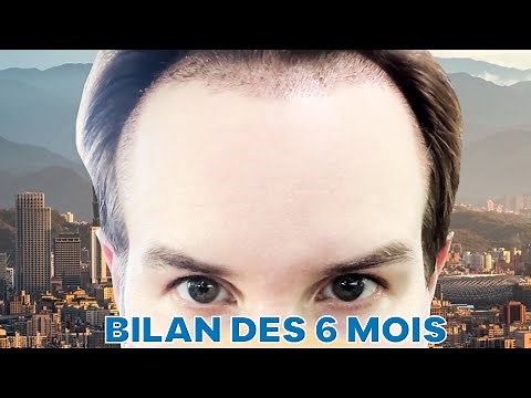 MA GREFFE A-T-ELLE RATE ?? BILAN DES 6 MOIS & TRAITEMENT DE l'ALOPECIE & DE LA CALVITIE