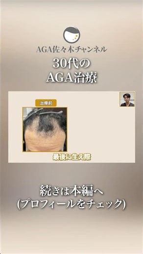 生え際は奥から変わる？AGA治療6ヶ月の経過