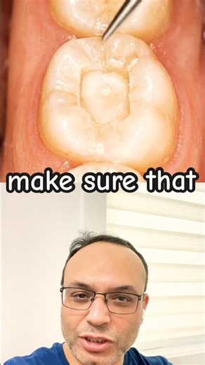 How a Cavity Is Filled 😳🦷