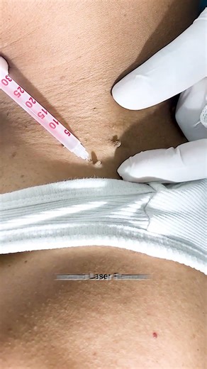 How Laser Treatment Removes Skin Tags Permanently || #skintagremoval #skincare