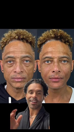 57K views · 16 reactions | Transformative Results with Biofiller ...