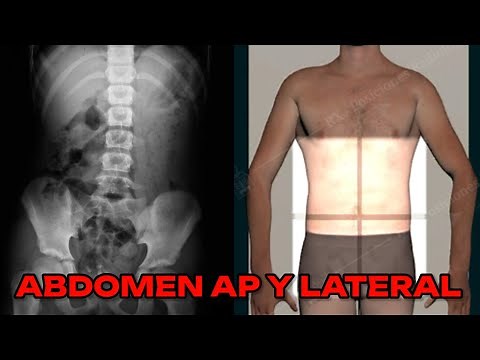 AP AND LATERAL ABDOMEN X-RAY (POCKET MANUAL) #14