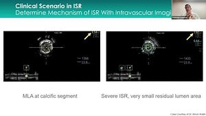 Master ISR Treatment: 5-Step DCB Algorithm