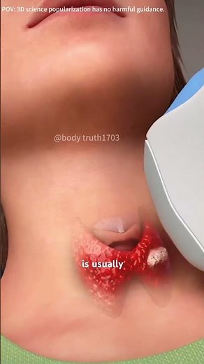 How Thyroid Biopsy Procedure Is Performed?(3D Animation ) #rain #doctor #cricothyroidotomy #gland