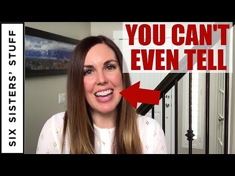 First day with Invisalign!