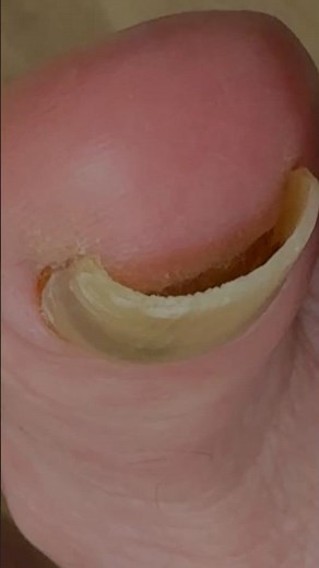 UP CLOSE! Toenail FUNGUS!