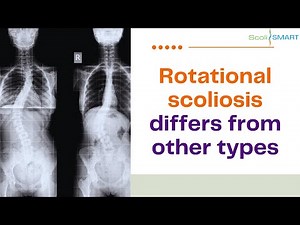 Rotational Scoliosis Explained | How It Differs from Other Scoliosis Types #Rotationalscoliosis