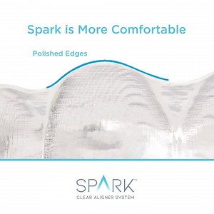 Concerned about pain during treatment? Spark™ uses material that is more comfortable compared to the leading competitor.* Spark custom aligners are designed with scalloped edges and smooth polished to enhance patient comfort.* Click here to get started on your journey to a more beautiful smile today: https://bit.ly/31PsN19 #SparkAligners *Data on file. | Spark Aligners | Facebook