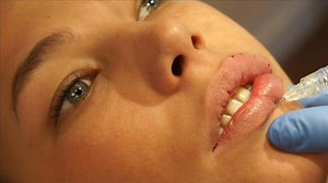 Lip Tenting Augmentation with Restylane