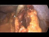 Laparoscopic Subtotal Colectomy, Inflammatory Bowel Disease • Video • MEDtube.net