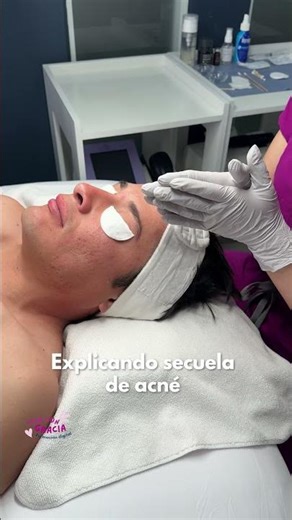 Explaining atrophic scarring as a result of acne! 💞🙌🏻