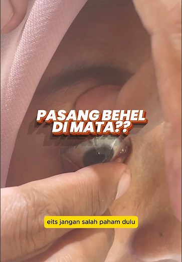 Pasang Terapi Ortokek untuk Mata - Solusi Tanpa Operasi