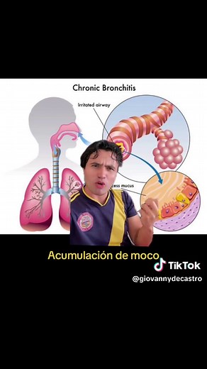 EPOC: Entendiendo la Enfermedad Pulmonar Crónica
