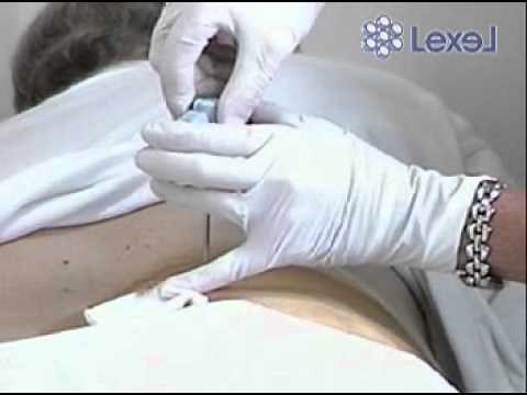 LEXELMEDICAL - BIOPSIA DE MEDULA OSEA