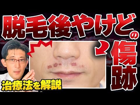 医療レーザー脱毛後のやけど その後の傷跡 #形成外科 #きずときずあとのクリニック #村松英之