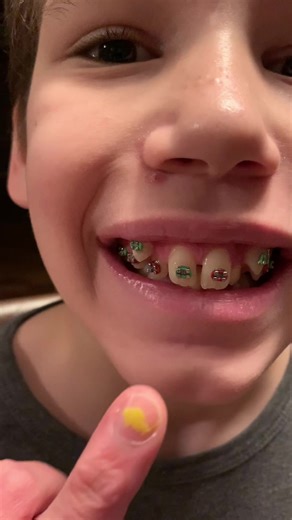 Replying to @Lithopsgrower You can definitely tell they were ready for bed and half asleep here 🤣 #palateexpander #braces #herbstappliance #progress