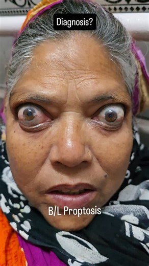 Eyelogy on Instagram: "In this 56-year-old female, bilateral proptosis is the most striking feature on inspection, with symmetrical forward displacement of both globes and widened palpebral fissures. Scleral show is evident in primary gaze, and lid retraction gives the eyes a characteristic ‘staring’ appearance. Extraocular movements are restricted—particularly in upgaze—suggesting involvement of the extraocular muscles. Conjunctival chemosis and mild periorbital edema are present, indicating or