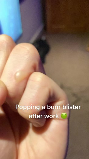 Popping a Burn Blister After Work