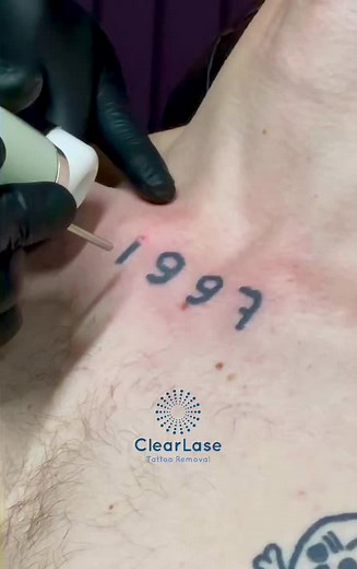 ClearLase Tattoo Removal on TikTok