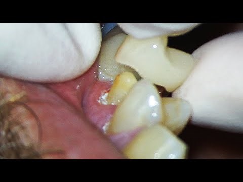 Dental Crown EXPLAINED (and how much Tooth You'll Lose)