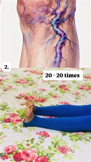 Vericose vein #youtube #viral