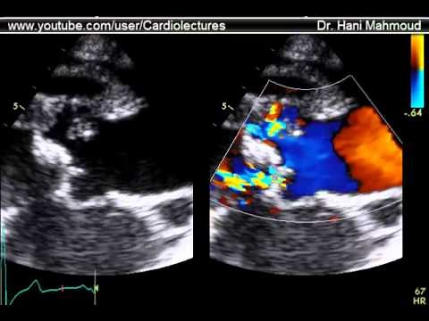 Infective Endocarditis - Aortic Root Abcess