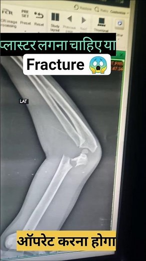 X Ray Elbow Ap/Lateral #Postion#Radiographer@Health.point