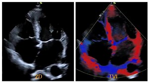 Apical four chamber view captured in exquisite detail, by probe S1-6P, working with our high end system #VINNOM86. | VINNO Ultrasound