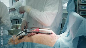 Surgeon uses sutures to close chest. Doctor uses absorbable sutures to close facial layer ensuring proper closure following coronary artery bypass procedure