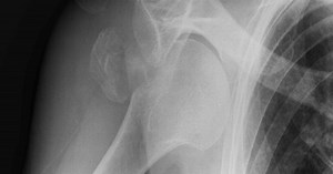 Spaso reductions and immobilisation