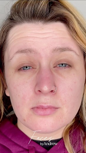 Baby Botox, also called micro-Botox, refers to a new trend in injectable Botox procedures. Baby Botox aims to smooth out wrinkles and fine lines, just like traditional Botox. But baby Botox uses less of the traditional Botox injectable. The aim of baby Botox is a face that looks smoother and vounger without the