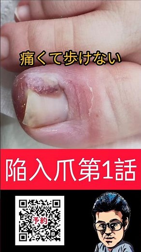 【陥入爪シリーズ】第1話 触れるだけでも痛くて飛び上がる程痛い爪の痛み #巻き爪 #皮膚科 #爪の痛み #フットケア #皮膚科
