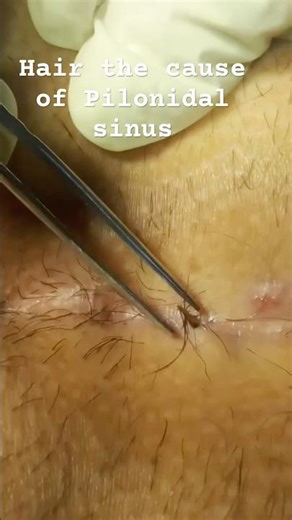 Pilonidal Sinus The root cause.