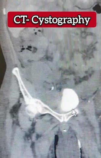 CT- CYSTOGRAPHY