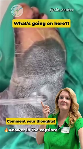 Spoiler alert VAC dressing! #WoundCare #AdvancedWoundHealing #ChronicWound #shorts