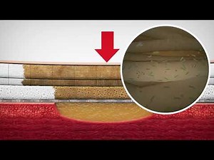 How it works Molnlycke Mepilex Flex-Foam Dressing?