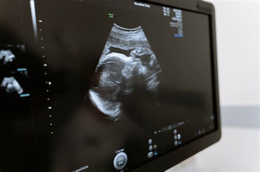 ¿Qué es un embarazo ectópico y por qué representaría la muerte inminente del bebé?
