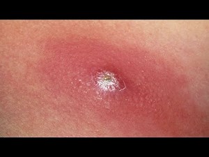 learn how to get rid of a boil easy