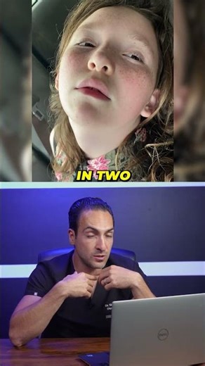 Mouth breathing deforms face!! #adenoidface #mouthbreathing #entdoctor